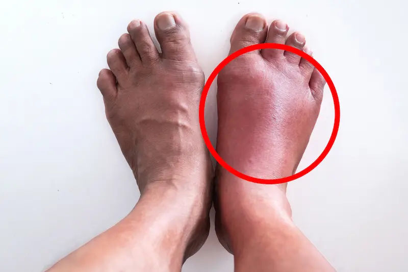 Reasons for Swelling in Feet